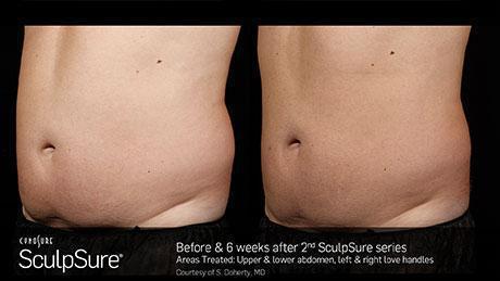 sculpsure-body-contouring-before-after10