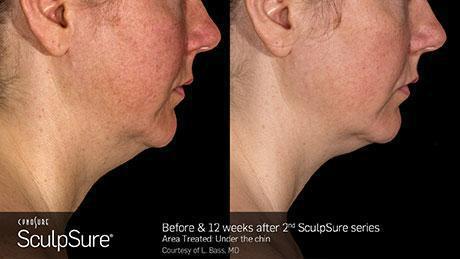 sculpsure-body-contouring-before-after2