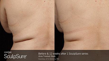 sculpsure-body-contouring-before-after3