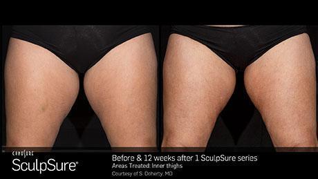 sculpsure-body-contouring-before-after5