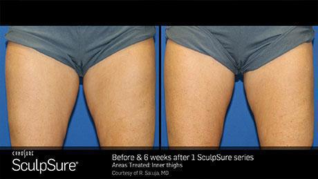 sculpsure-body-contouring-before-after6