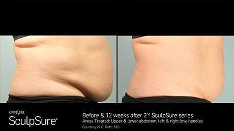 sculpsure-body-contouring-before-after8