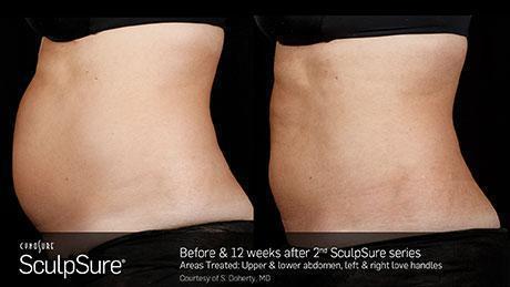 sculpsure-body-contouring-before-after9