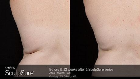 sculpsure-body-contouring-before-after4